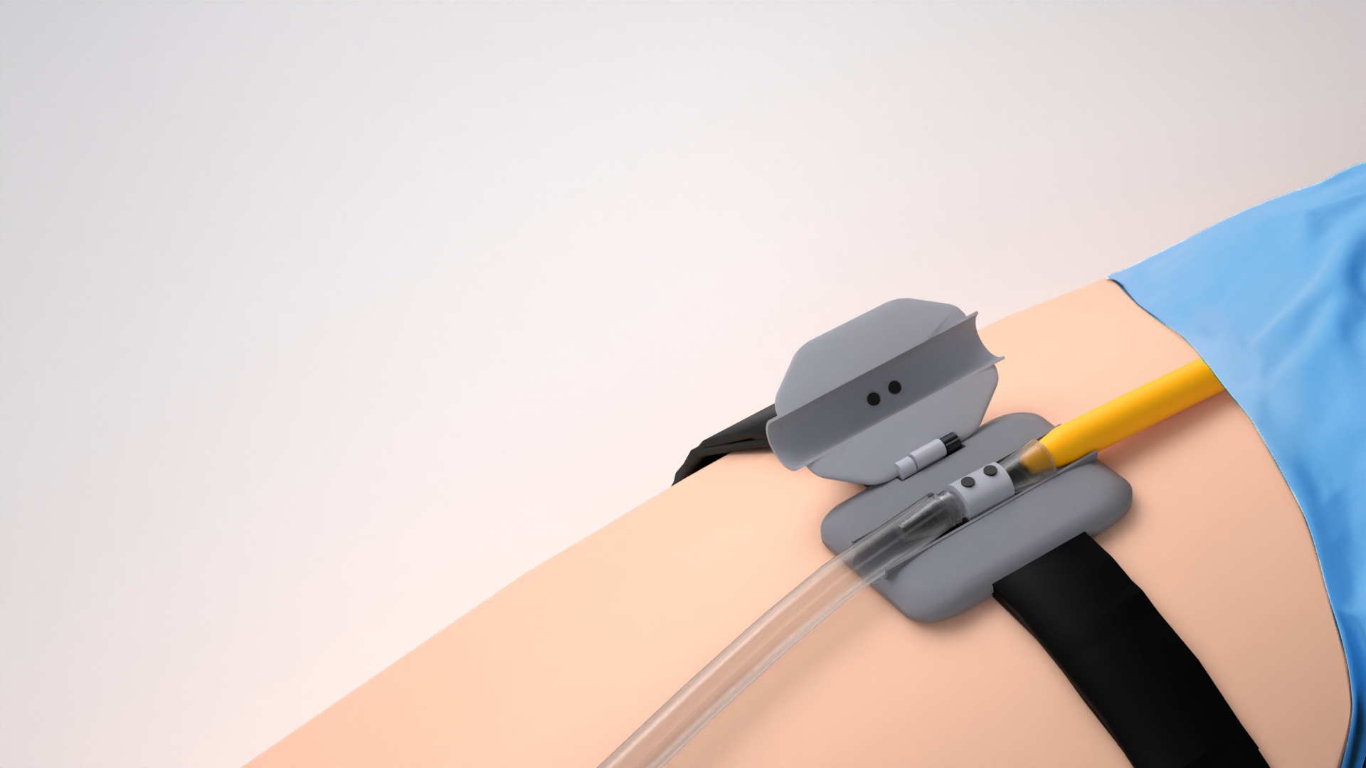 Device shown on patient leg in hospital context